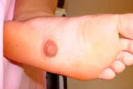 pseudomamma-foot.jpg